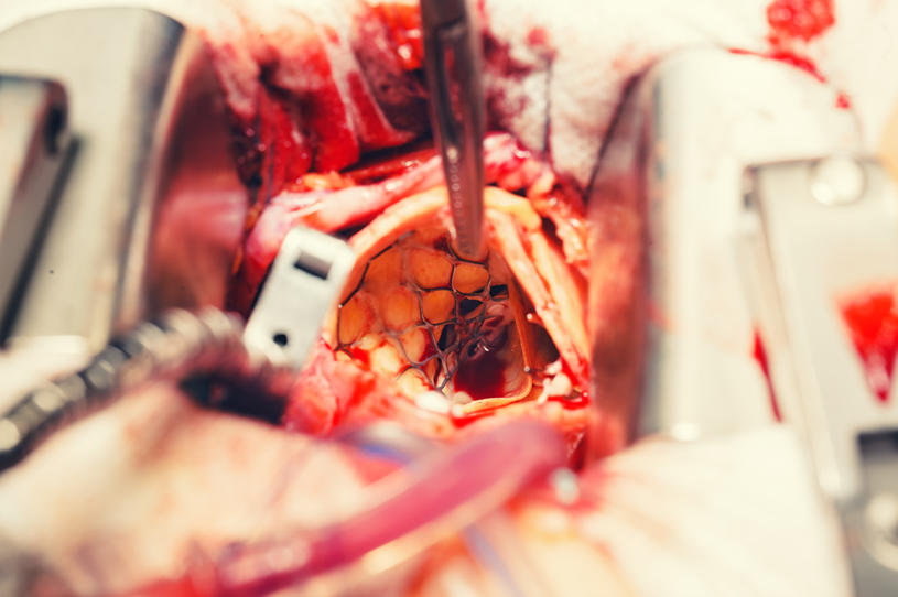 Aortic Valve Treatment TAVR