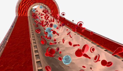 Intravascular Lithotripsy